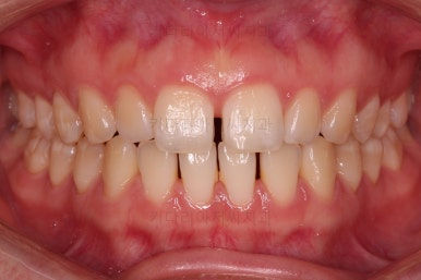 부산벌어진치아교정