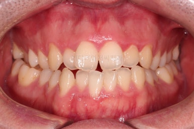 부산긴얼굴긴턱교정