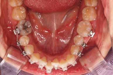 부산비발치교정