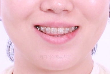 부산치아교정잘하는곳