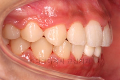 연산동치아교정