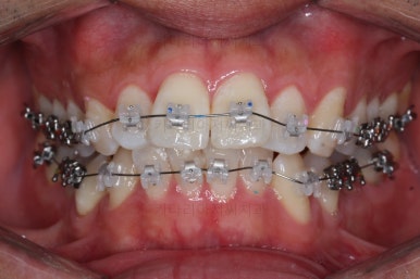 부산교정치과추천