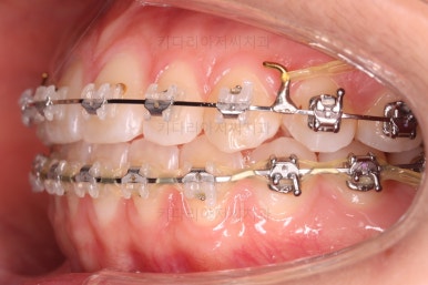 부산치아교정잘하는곳