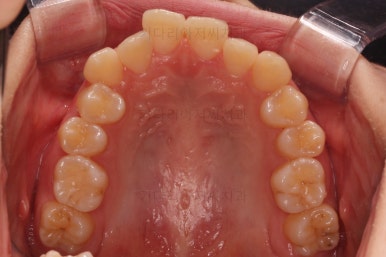 부산돌출입교정