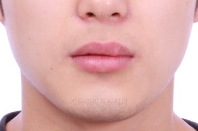 연산동치아교정