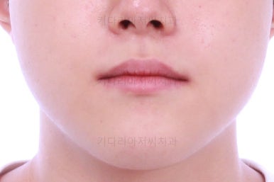 부산주걱턱교정