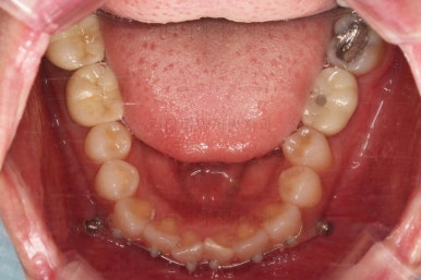 부산부분치아교정