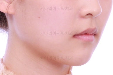 부산클리피씨교정