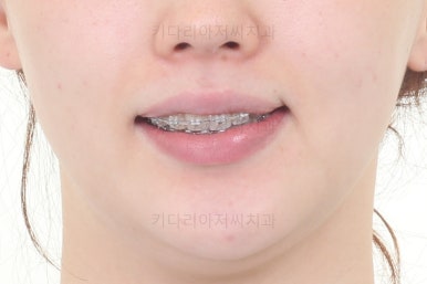 부산비대칭교정