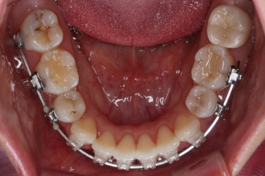 부산연산동교정치과