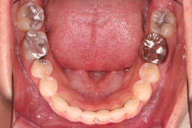 부산안면비대칭