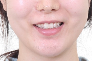 부산부분치아교정