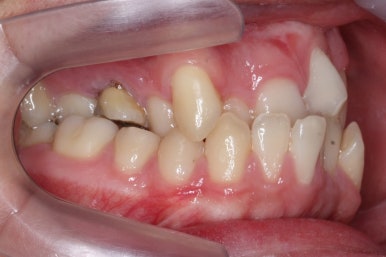 부산구순구개열