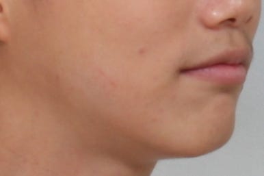 부산왜소치교정