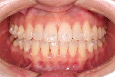 부산인비절라인