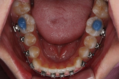 부산비발치교정