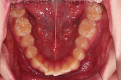 부산연산동사랑니발치