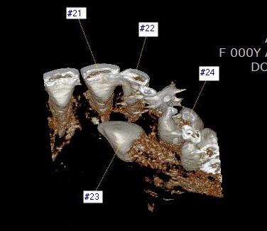 부산매복치아교정