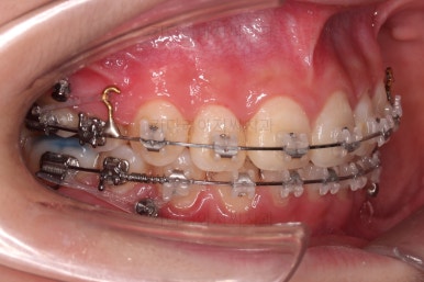 연산동치아교정