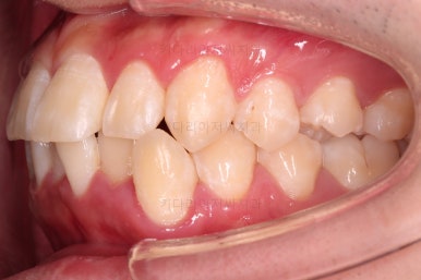 부산돌출입교정