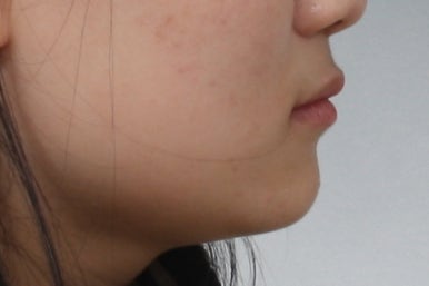 부산매복치아교정