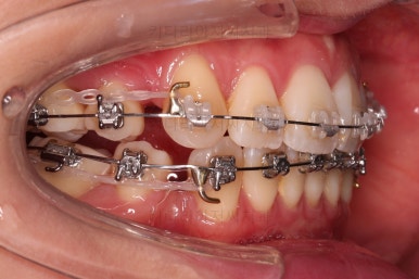 부산치아교정잘하는치과