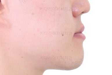 부산비수술교정