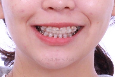 부산사랑니교정