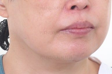 동래임플란트교정