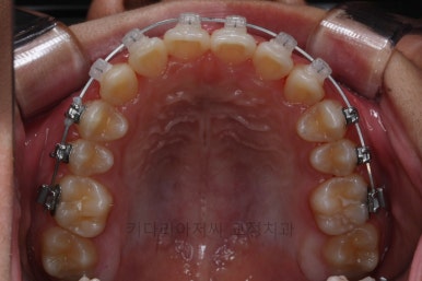 연산동치아교정