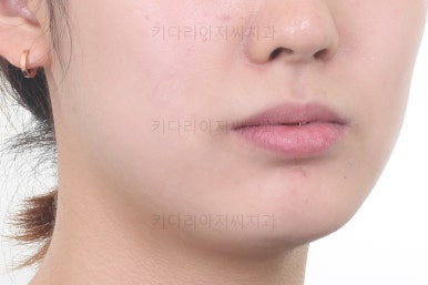 부산안면비대칭