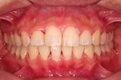 부산연산역치아교정