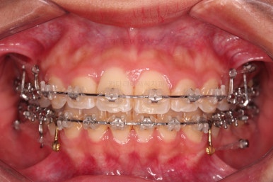 부산연산역치아교정