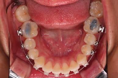 부산연산역치아교정