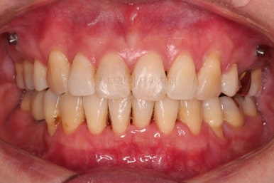 동래임플란트교정