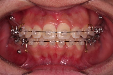 부산청소년치아교정