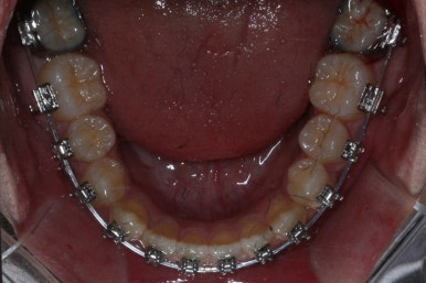 부산주걱턱교정