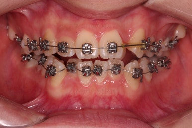 동래구치아교정