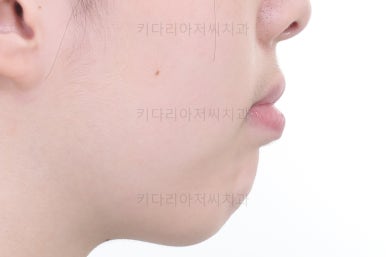 부산투명교정