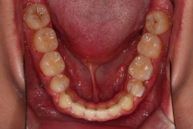 부산주걱턱교정