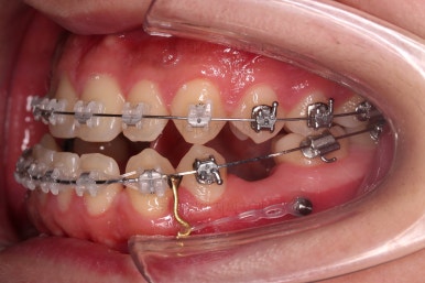 부산주걱턱교정