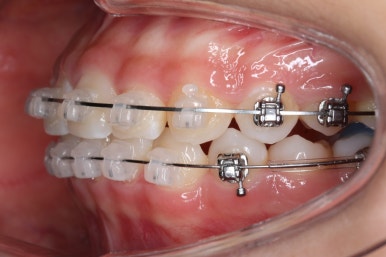 부산치아교정잘하는곳