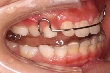 부산어린이돌출입교정