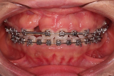 부산구순구개열