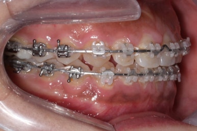 부산치아교정치과