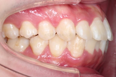 부산돌출입교정