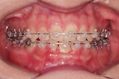 부산교정치과추천