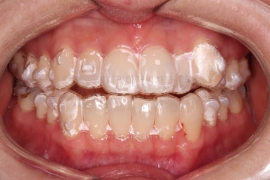 부산인비절라인