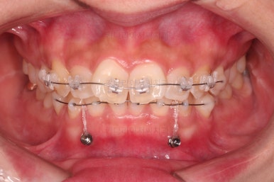 부산앞니부분교정