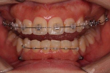 부산무턱교정치과